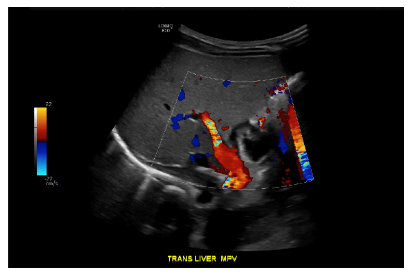 Ultrasound doppler